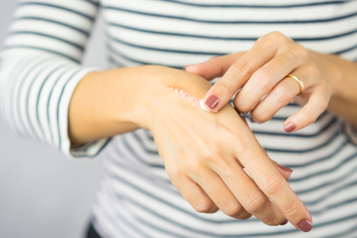 heat burn on her hand.