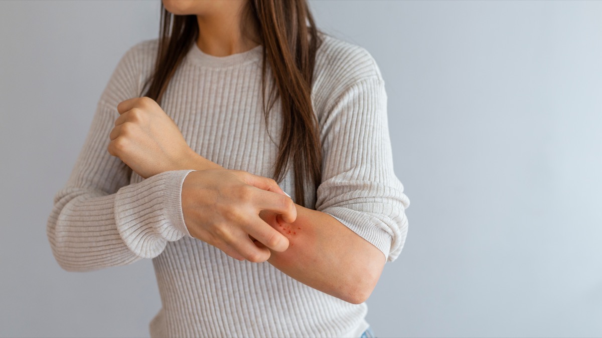 young woman scratching her arm with allergy rash