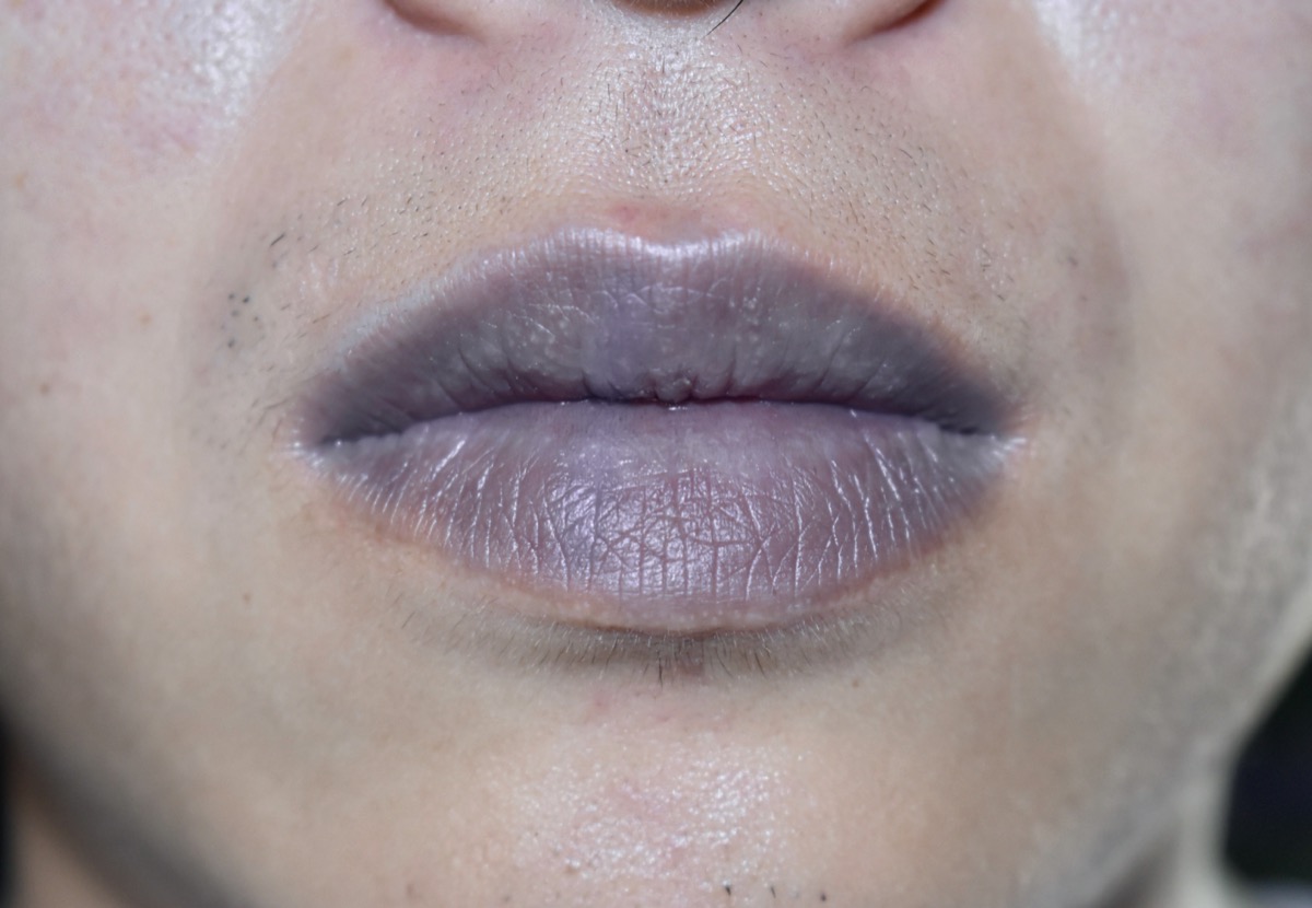 What Are The Symptoms Of Blue Lips