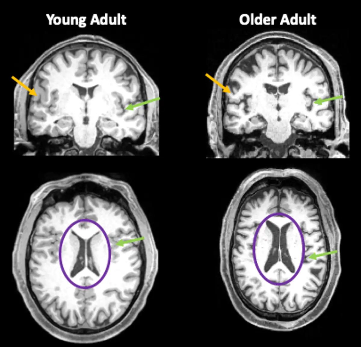 Brain images from a 35-year-old and an 85-year-old