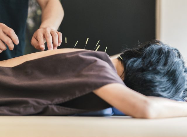 woman getting acupuncture on back on table