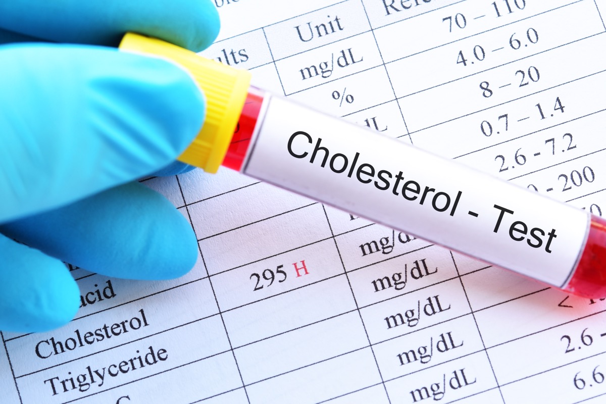 Blood,Sample,Tube,With,Abnormal,High,Cholesterol,Test,Result