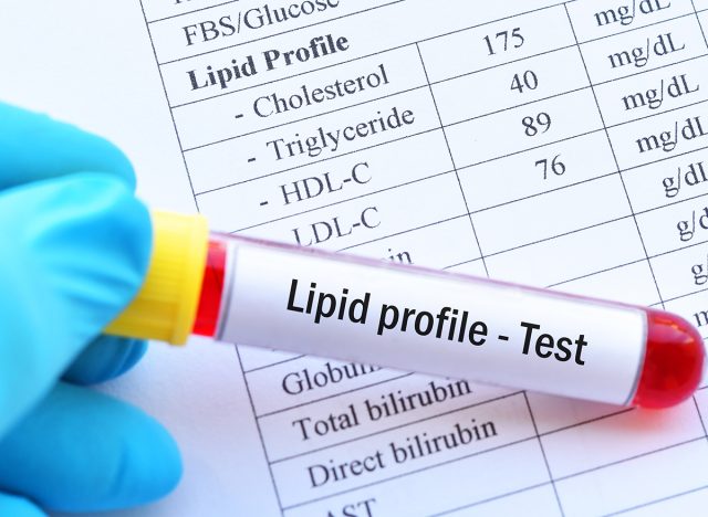 Blood sample with normal lipid profile result